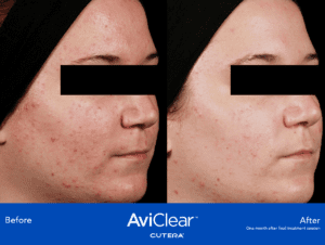 Before and after AviClear Acne Treatment