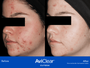 Before and after AviClear Acne Treatment