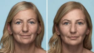 Before and after Radiesse Treatment