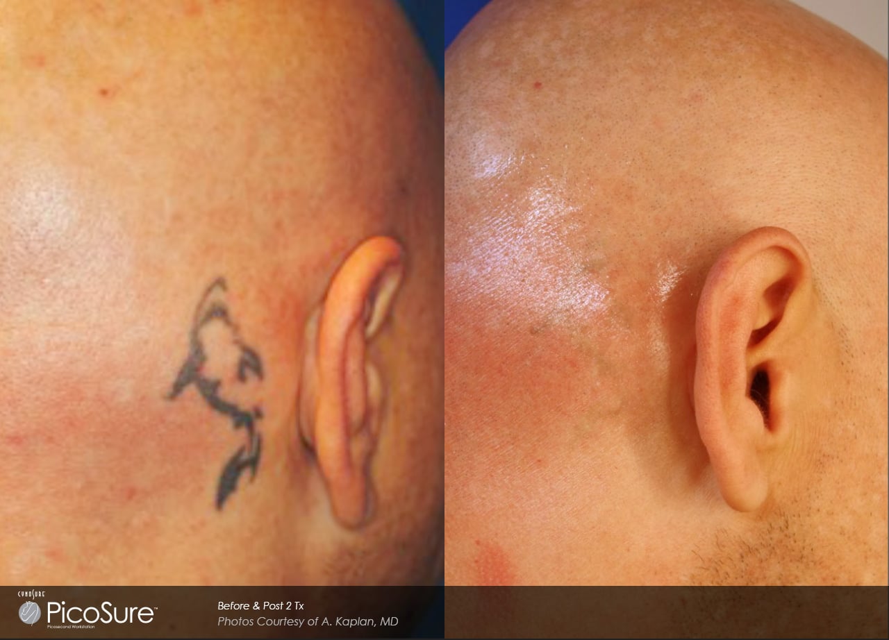 Tattoo Removal Specialists in Charlotte NC  Ask for Cost
