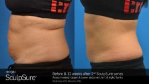 Before and after SculpSure Body Contouring Treatment