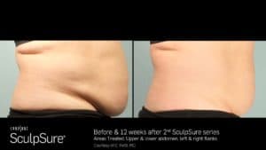 Before and after SculpSure Body Contouring Treatment